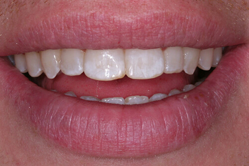 Fixed Ceramic Braces Southend on Sea